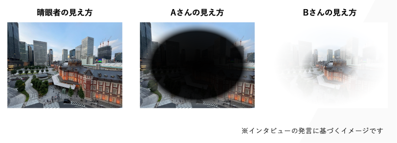 左から順に、晴眼者の見え方、Aさんの見え方（中央が大きく黒く欠けており、周辺のみが見える）、Bさんの見え方（全体が白くぼやけており、中心が少し見える）