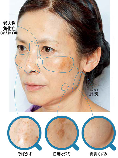 医師が鑑定！シミの種類別おすすめスキンケア方法（HALMEK up）